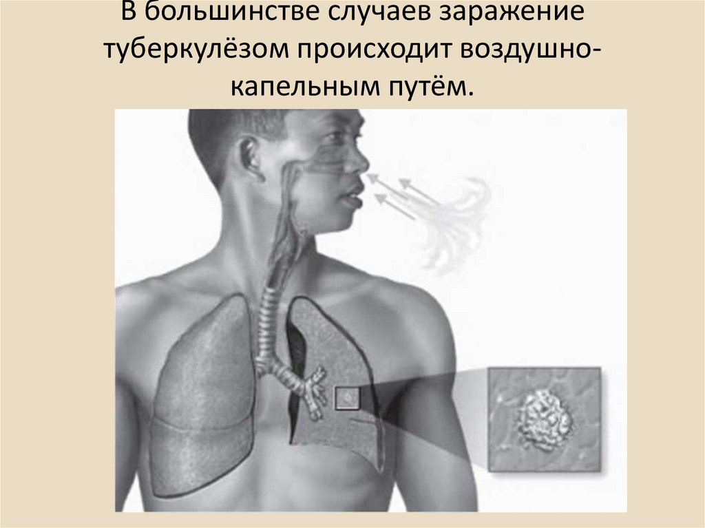 В большинстве случаев. Можно ли заразиться туберкулезом воздушно капельным путем. Подробнее о заражении туберкулезом воздушно капельным путем. Воздушно капельным путем в тебя проник Артем. Почему люди не заражаються туберкулёзом воздушно капельным путем.