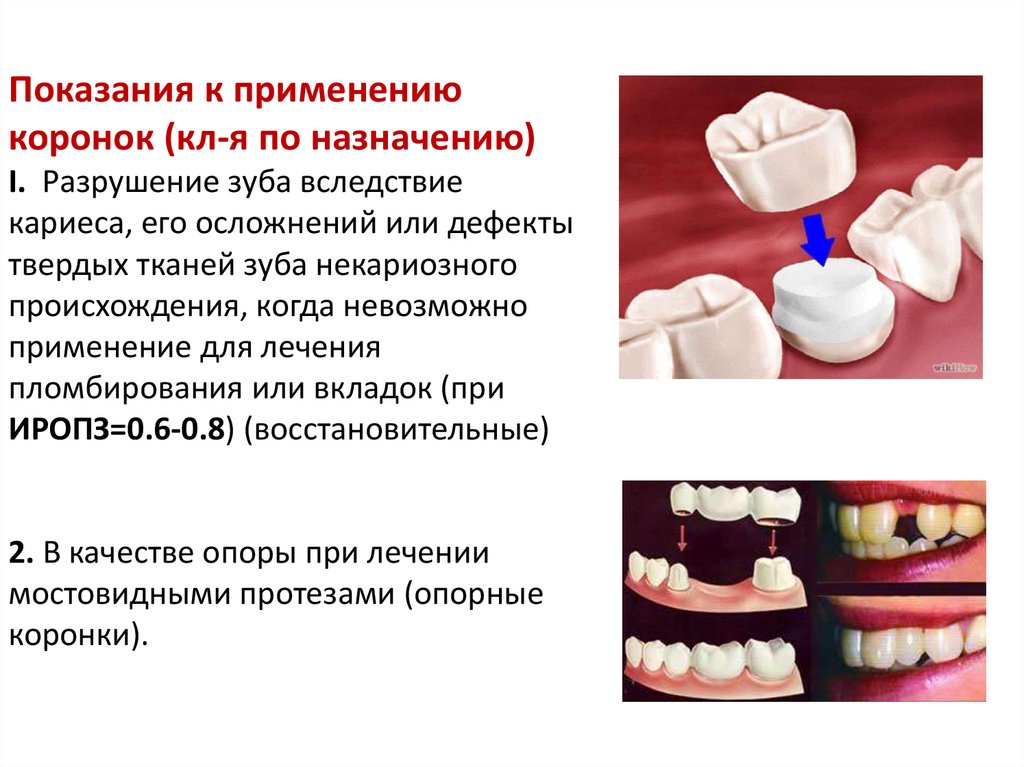Какую функцию выполняет коронка зуба. Классификация дефектов коронок. Классификация дефектов твердых тканей коронки зуба. Фарфоровые коронки клинико лабораторные. Зубная штампованная металлическая коронка.
