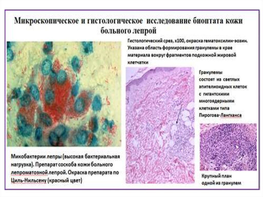 Патогенные микобактерии. Атипичные микобактерии. Атипичные микобактерии микробиология. Атипичные микобактерии гистология.