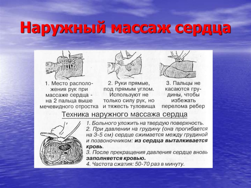 Как следует расположены. Проведение наружного массажа сердца. Методика проведения наружного массажа сердца. Каковы параметры наружного массажа сердца?. Наружный массаж сердца методика.