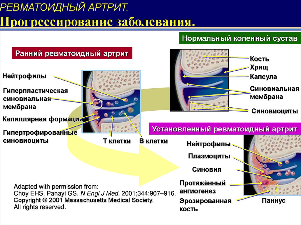 Ревматоидты артрит презентация