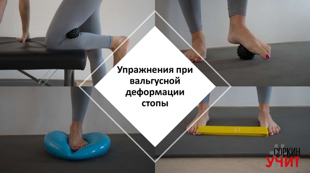 Упражнения при вальгусной деформации стопы