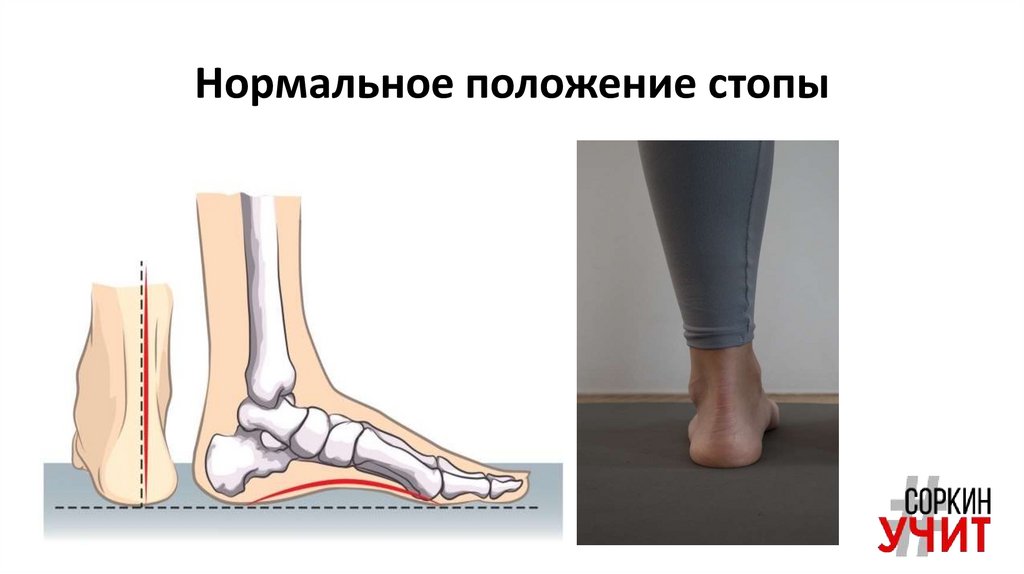 Правильное положение стопы. Пронация и супинация стопы. Правильное положение стоп. Вальгусная и варусная деформация. Правильная постановка стоп при ходьбе.