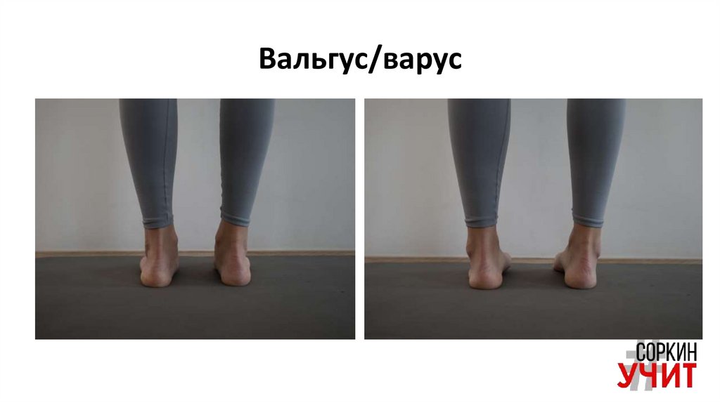 Вальгус/варус