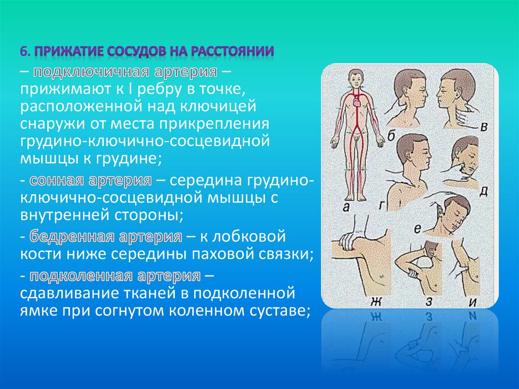 Как производится пальцевое прижатие подключичной артерии. Пальцевое прижатие подключичной. Прижатие подключичной артерии. Пальцевого прижатия сонной артерии. Точки прижатия артерий для остановки кровотечения.