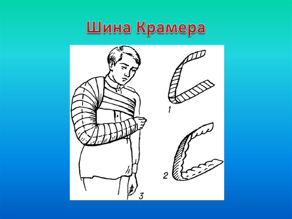 Проволочная шина крамера. Перелом плечевой кости шина Крамера. Иммобилизация шиной Крамера. Шина Дитерихса и шина Крамера. Шина Крамера при переломе плечевой кости.