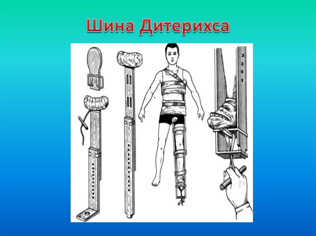 Шина бедро голень. Транспортная иммобилизация перелома бедра шиной Дитерихса. Иммобилизация шиной Дитерихса при переломе бедра. Перелом бедра шина Дитерихса. Наложение шины Дитерихса.