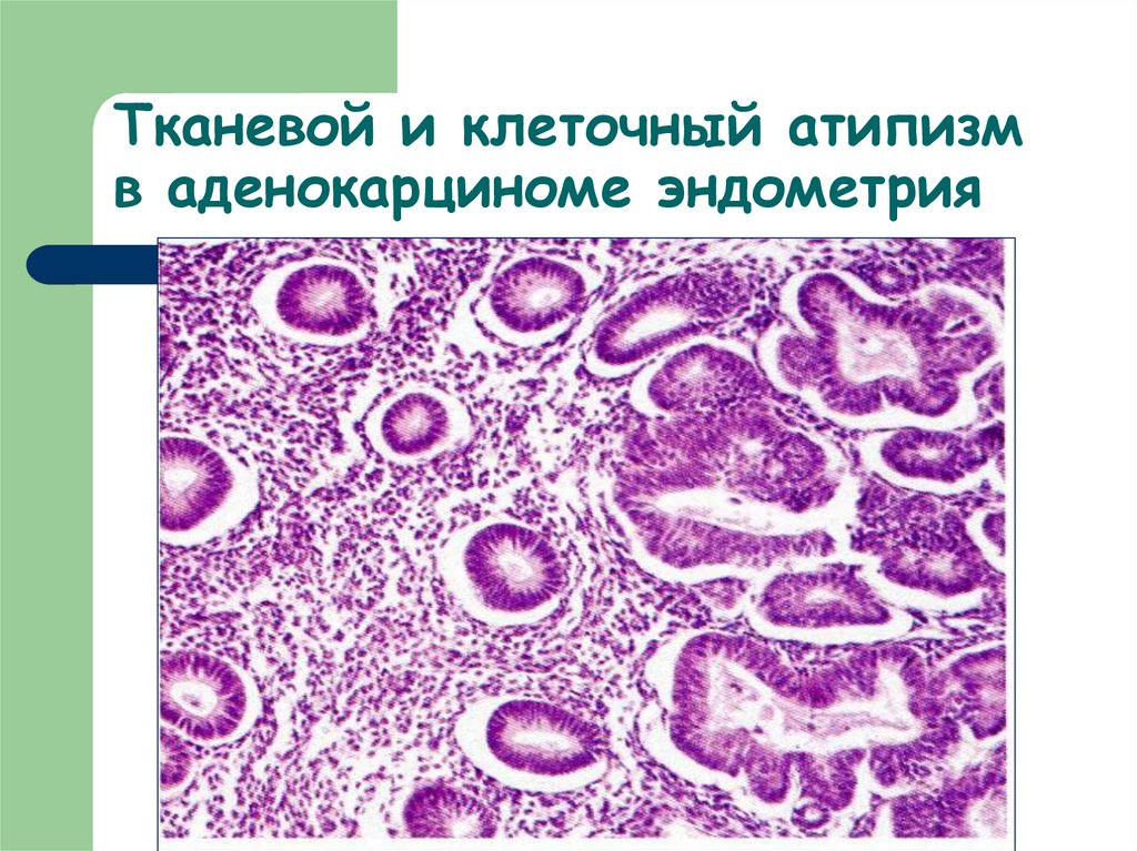 Тканевой атипизм рисунок