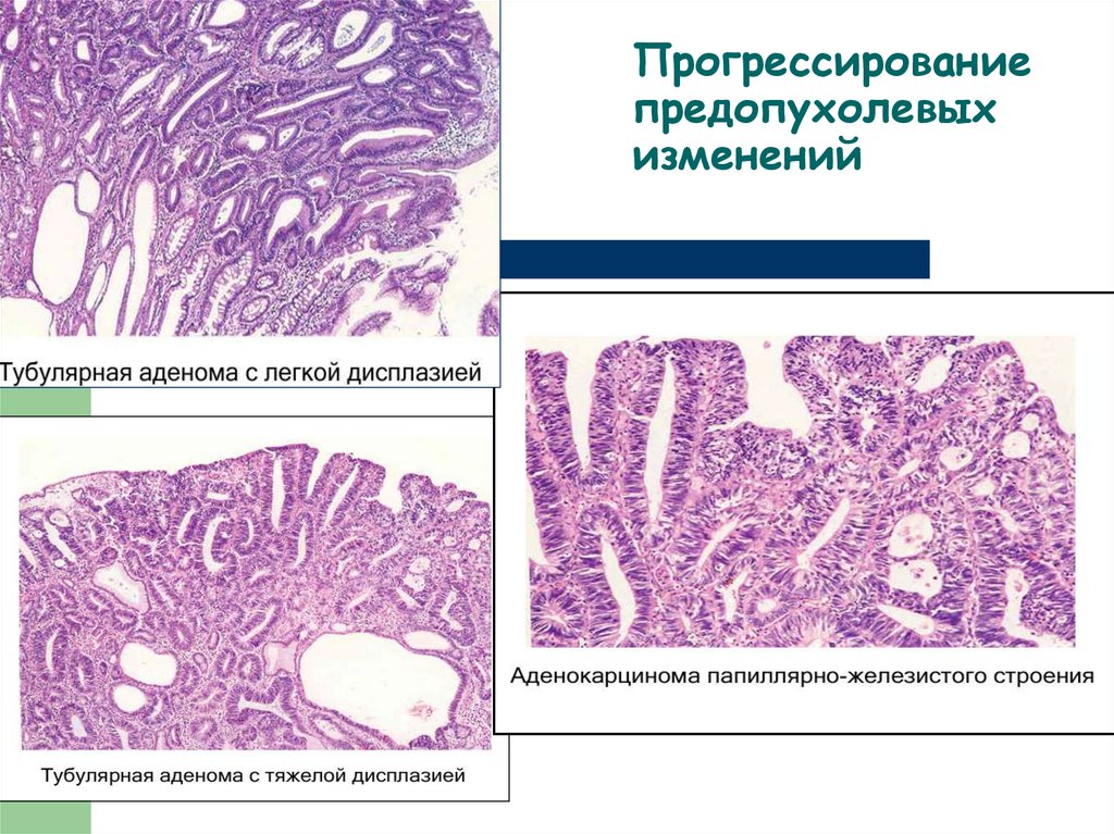 Предопухолевые процессы презентация