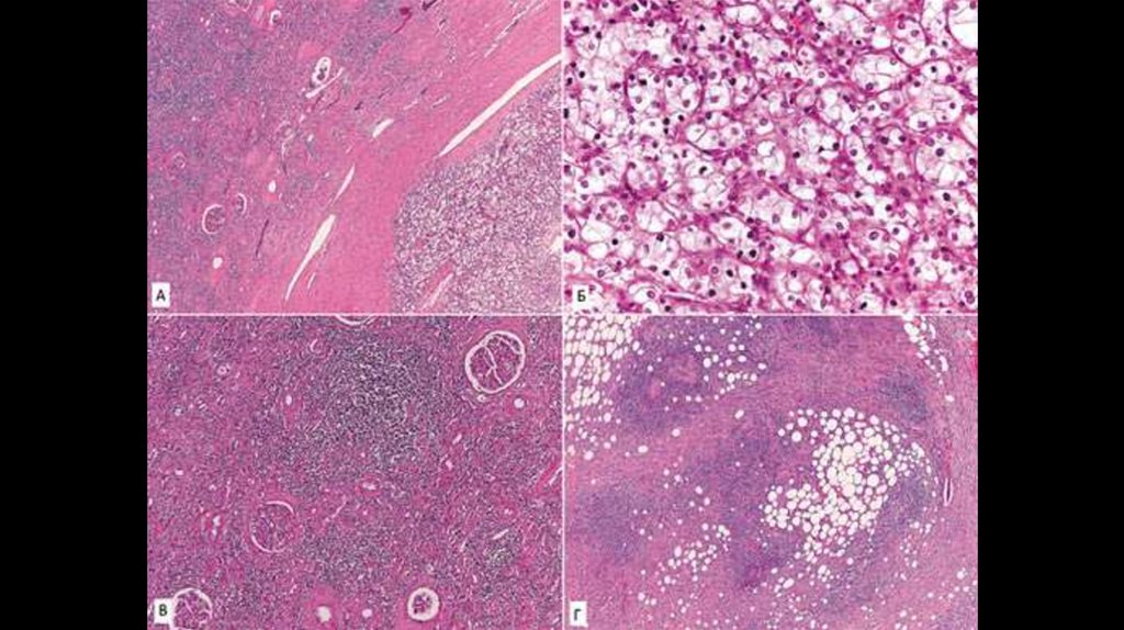 Фиброзная ткань. Светлоклеточная карцинома почки гистология. Аденокарцинома почки гистология. Светлоклеточная аденокарцинома почки. Светлоклеточная аденома почки гистология.