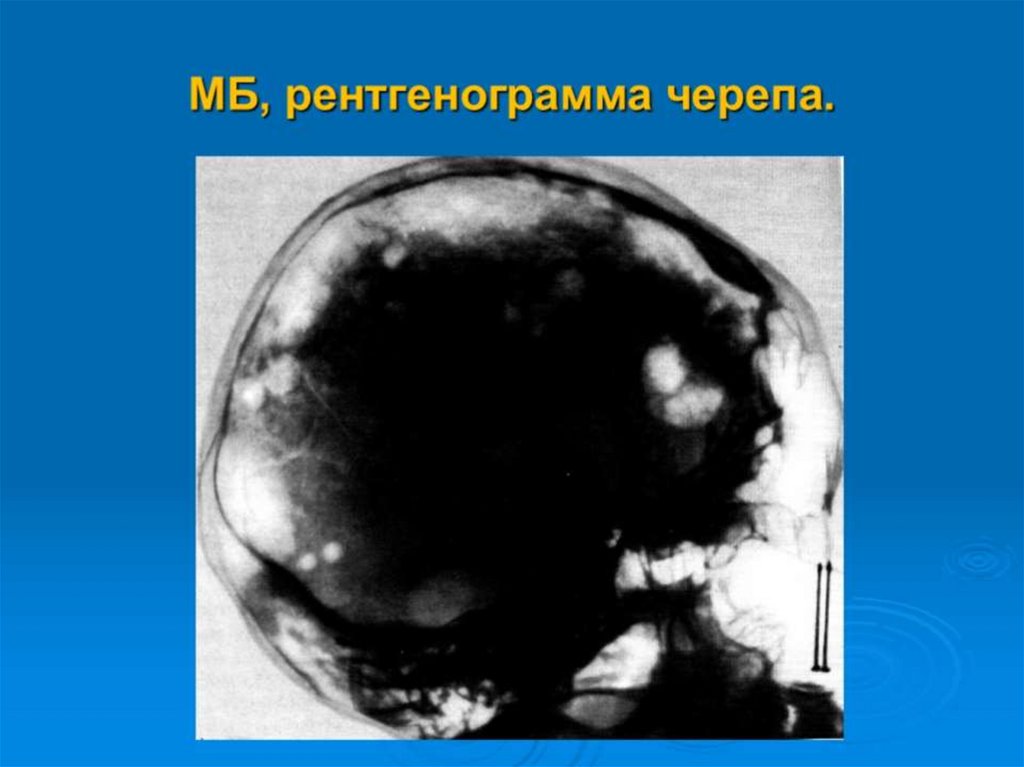 МБ, рентгенограмма черепа.