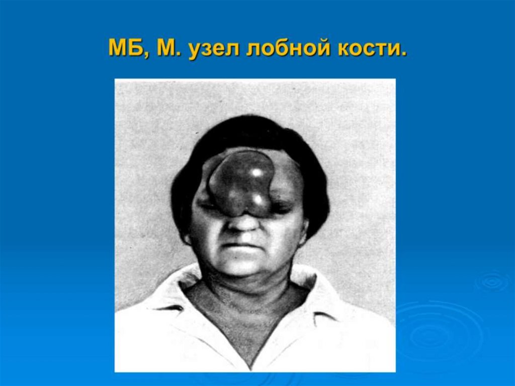 МБ, М. узел лобной кости.