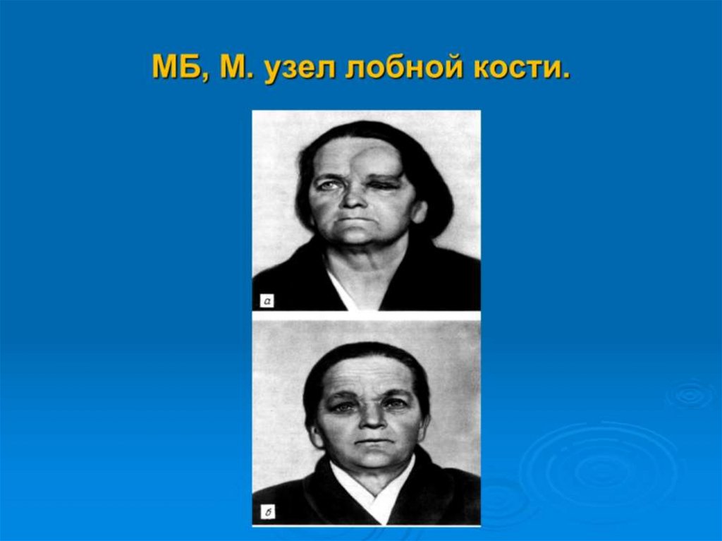 МБ, М. узел лобной кости.