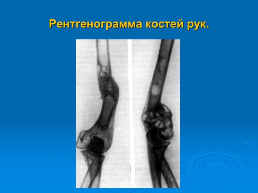 Рентгенограмма костей рук.