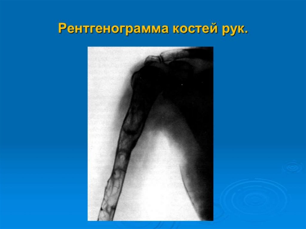 Рентгенограмма костей рук.