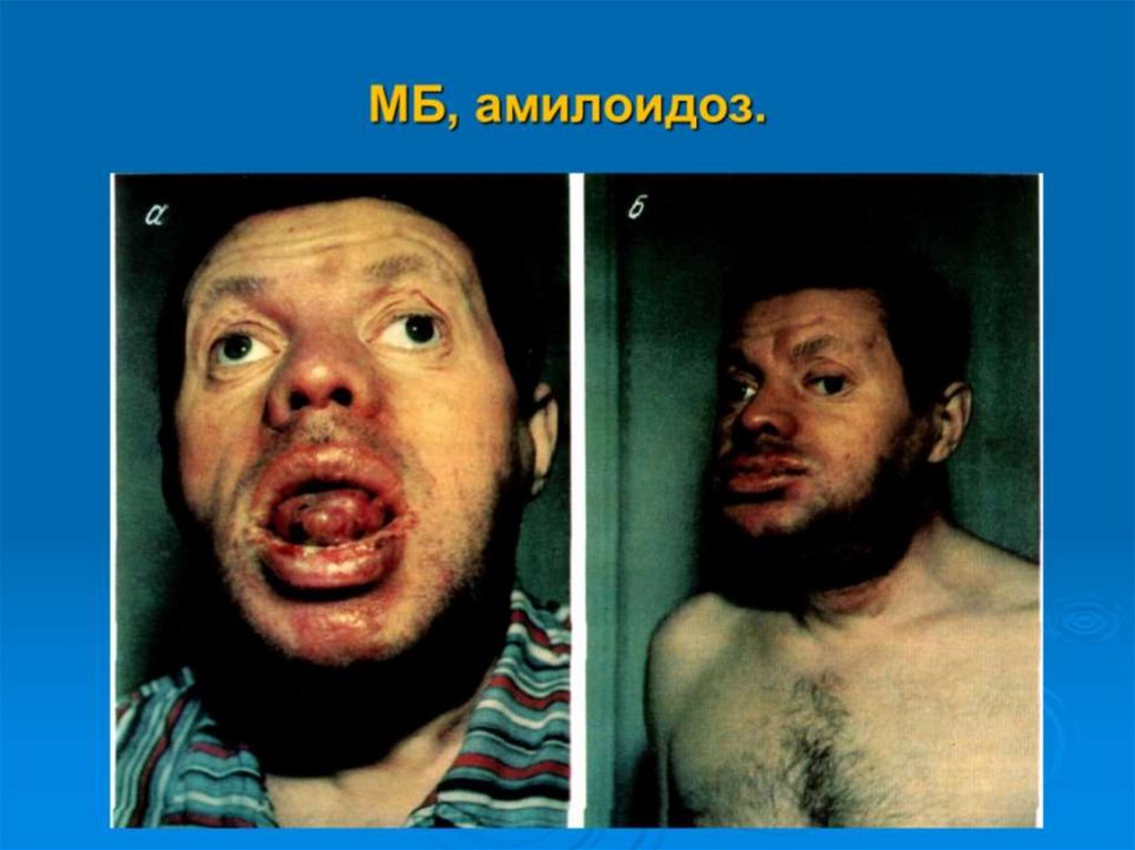 МБ, амилоидоз.
