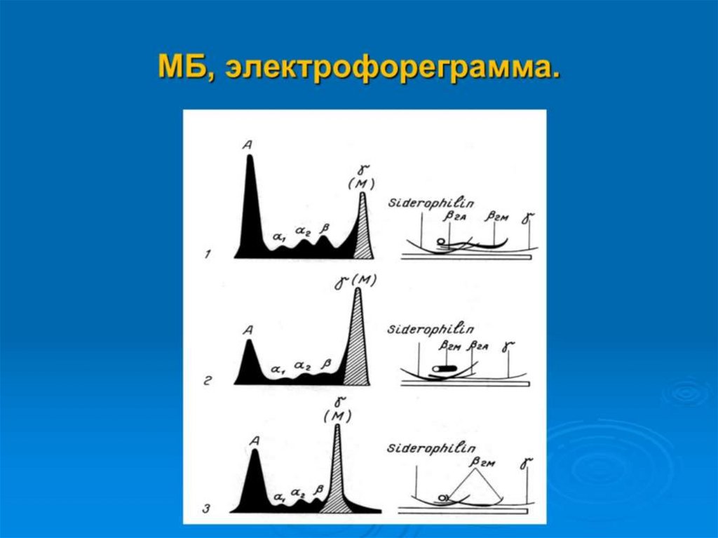 МБ, электрофореграмма.