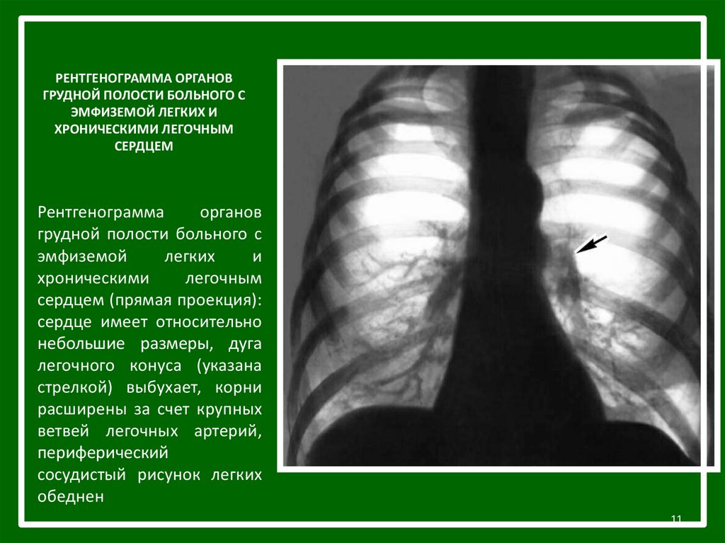 Полость страдать. Рентген при эмфиземе легких. Рентгенологические признаки эмфиземы легких. Хроническое легочное сердце рентгенограмма. Буллезная эмфизема рентген.