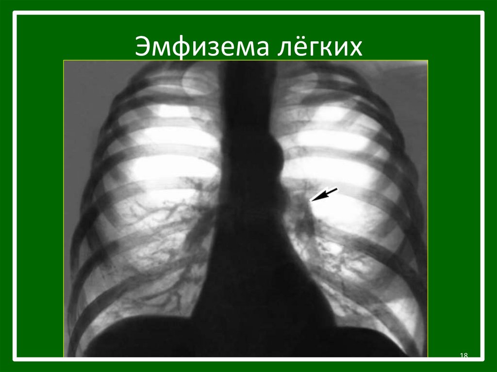 Эмфизема это. Эмфизема рентгенография. Пневмосклероз рентген. Эмфизема легкого рентгенограмма. Эмфизема легких снимок рентген.