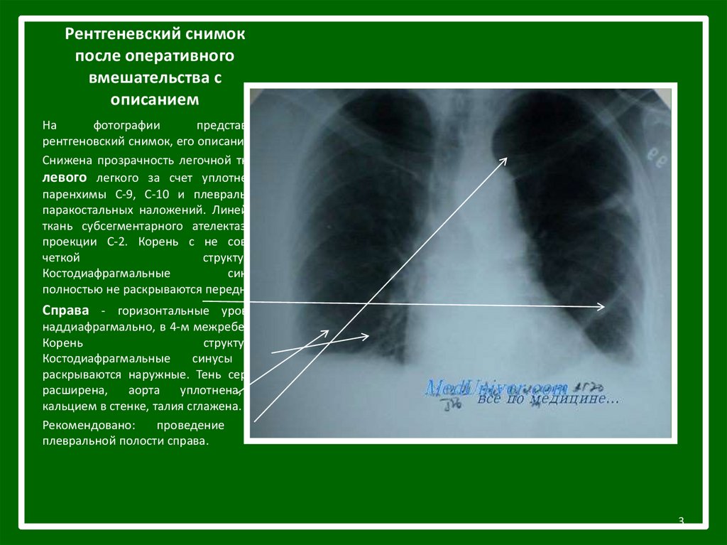Что значит рентген. Рентгенография легких с описанием. Описание рентгеновских снимков. Рентген снимки с описанием. Снимки легких с описанием.