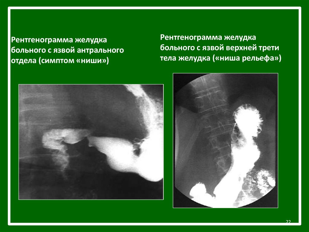 Рентгенография желудка презентация