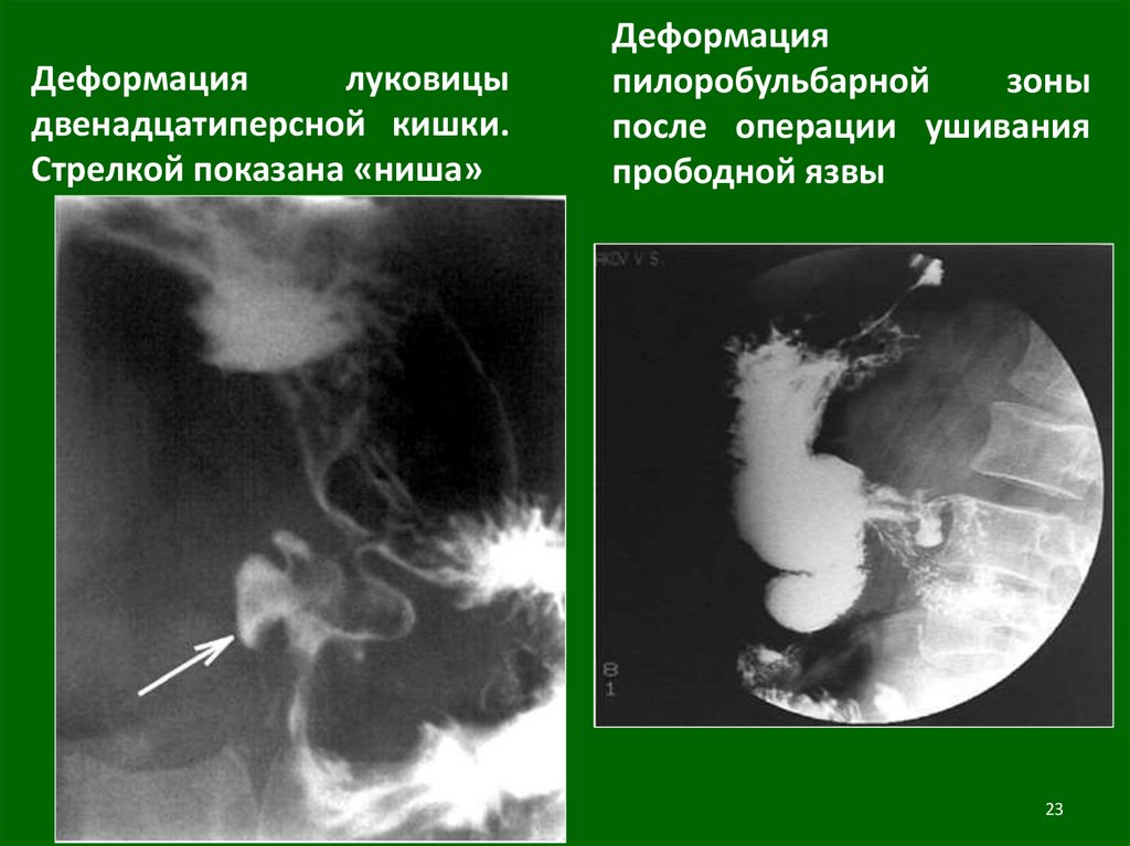 Рентгеноскопия двенадцатиперстной кишки. Деформация луковицы двенадцатиперстной кишки. Деформация пилоробульбарной зоны. Рубцовая деформация ЛДПК. Рубцово-язвенная деформация 12 перстной кишки.