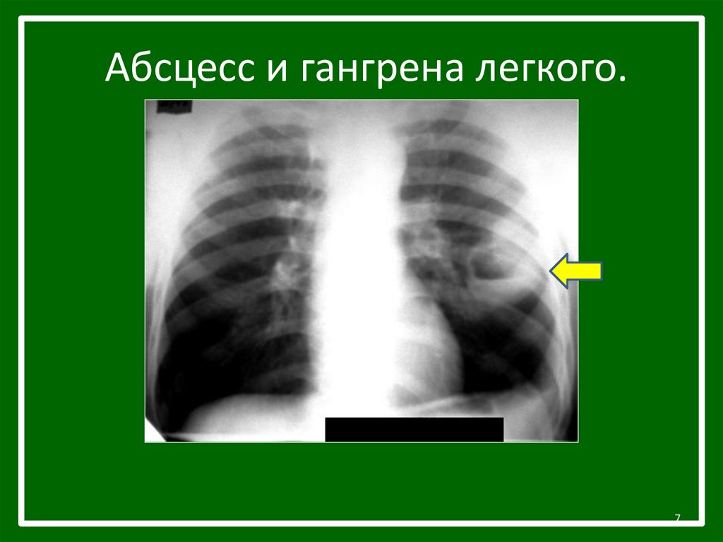 Гангрена легкого презентация