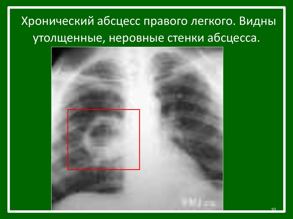 Рентгенологическая картина при абсцессе