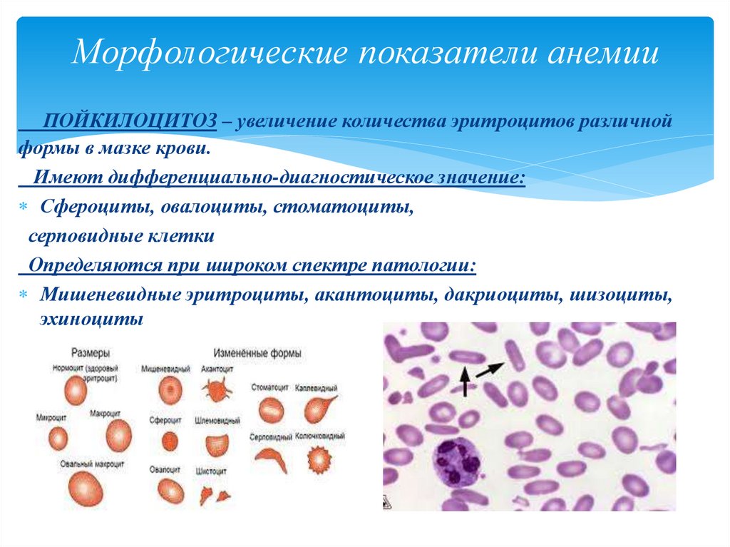 Большое содержание эритроцитов. Б12 дефицитная анемия кровь. Морфологические изменения эритроцитов при железодефицитной анемии. Серповидноклеточная анемия эритроциты.