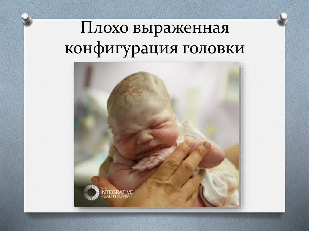 Плохо выраженная конфигурация головки