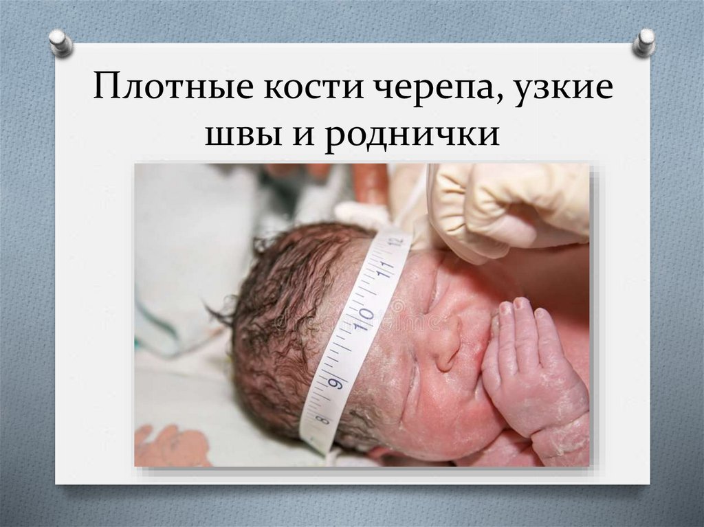 Плотные кости черепа, узкие швы и роднички