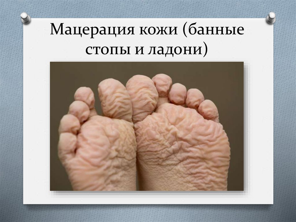 Мацерация кожи (банные стопы и ладони)