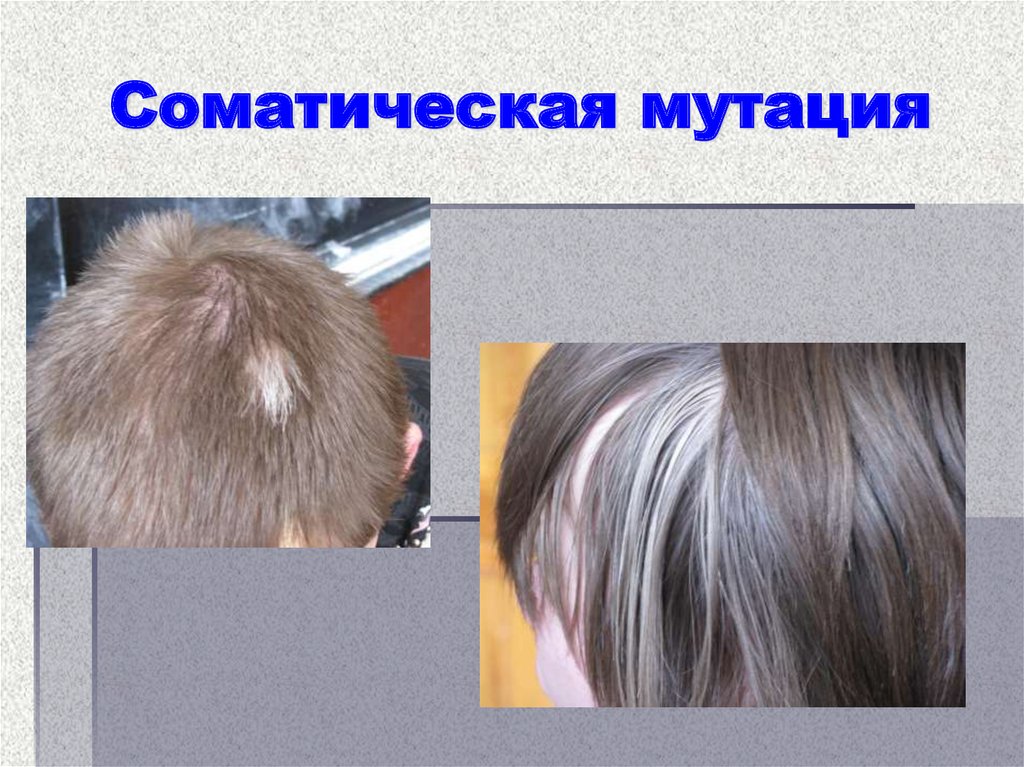 Какая мутация обуславливает формирование белой пряди волос у человека
