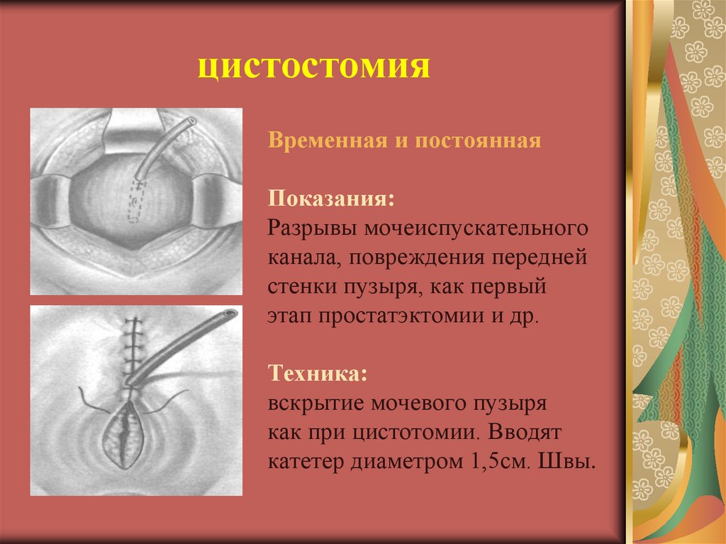 Цистостомия у мужчин