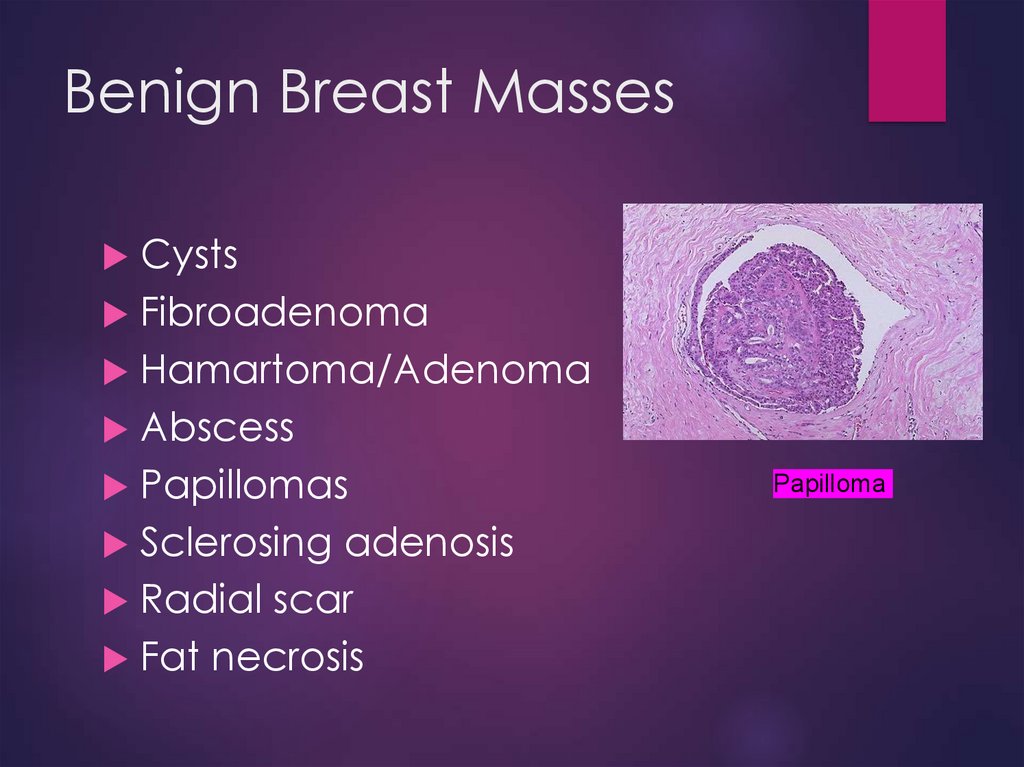 Benign Breast Masses