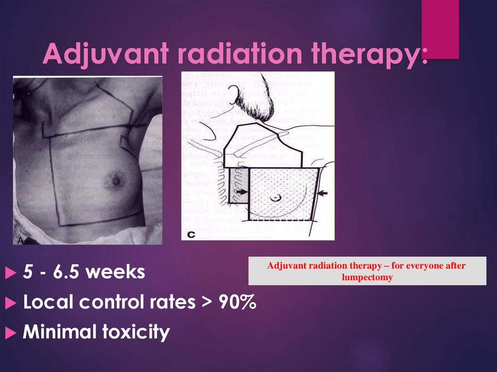 Adjuvant radiation therapy: