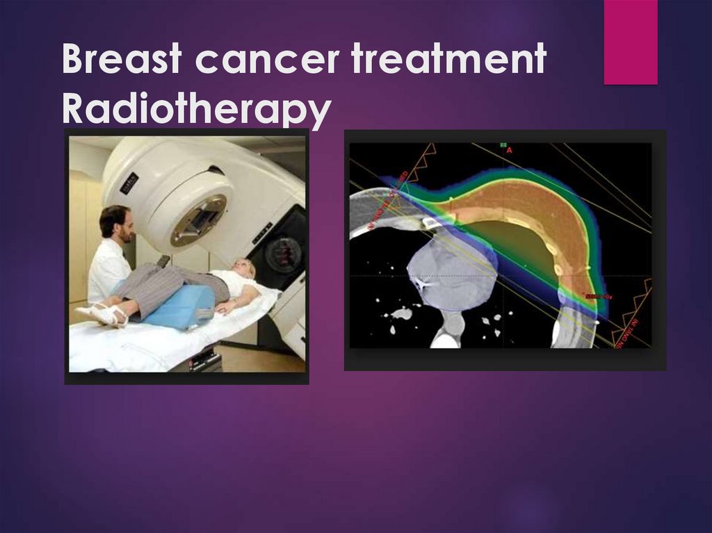 Breast cancer treatment Radiotherapy  