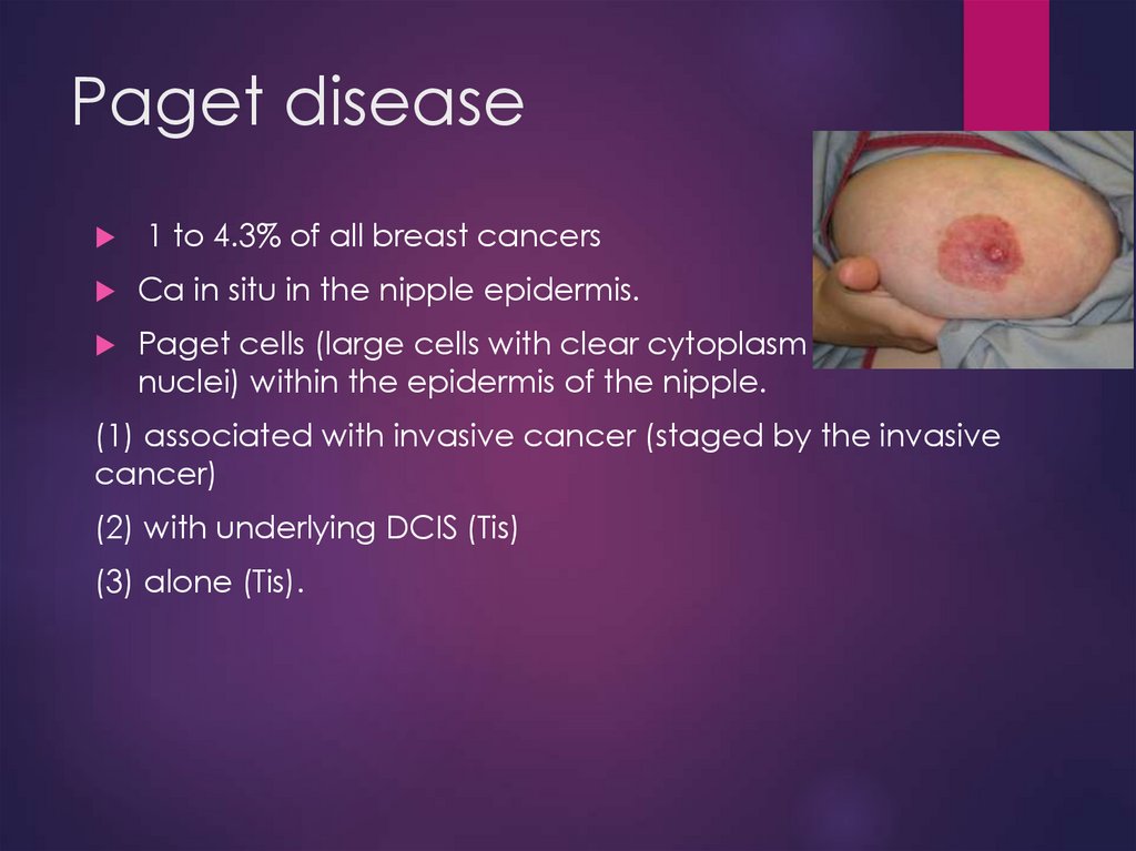 Paget disease