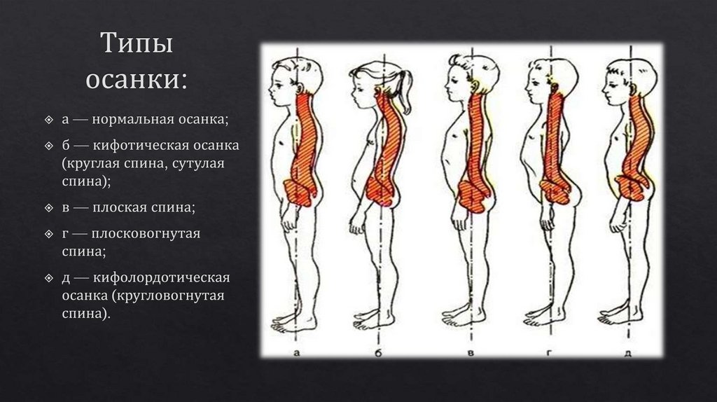 Типы осанки. Кифолордотическая осанка. Кифотический Тип осанки. Степени нарушений кифотической осанки:. Кифосколиотический Тип осанки.