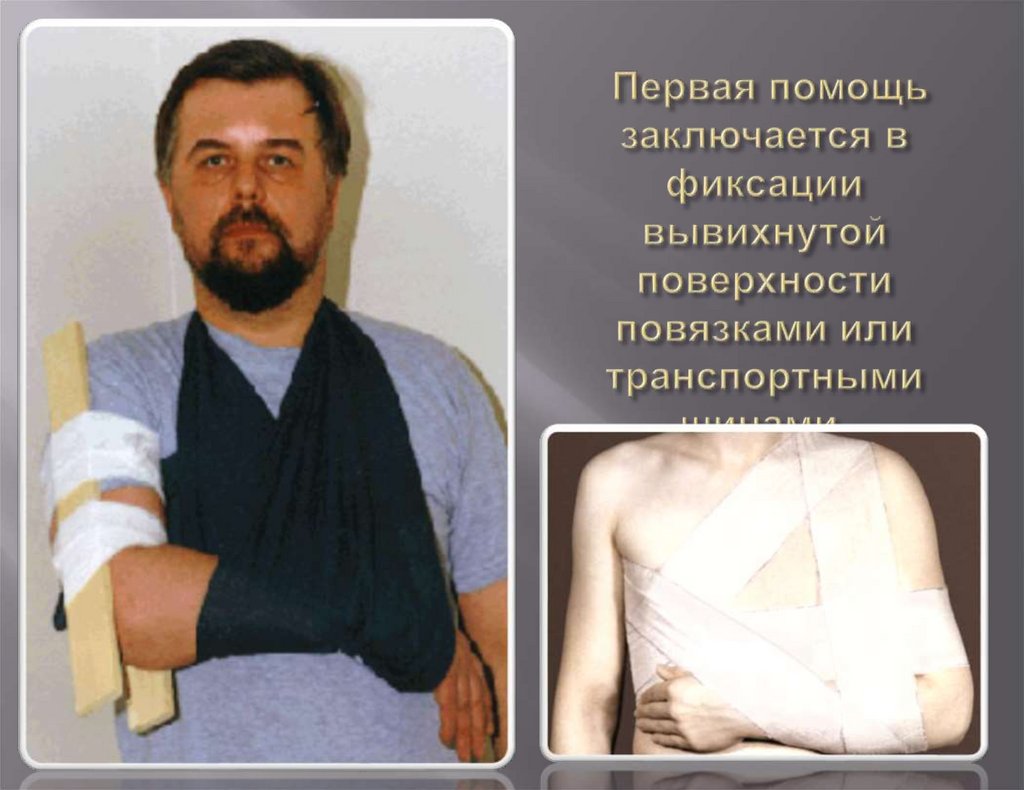 Первая помощь заключается в фиксации вывихнутой поверхности повязками или транспортными шинами.