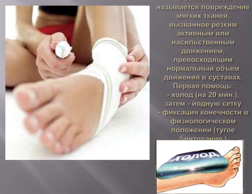 Растяжением называется повреждение мягких тканей, вызванное резким активным или насильственным движением, превосходящим