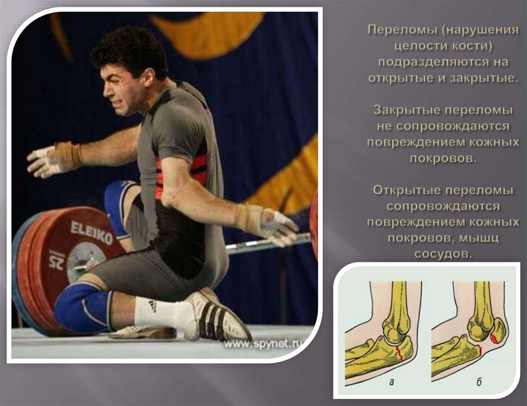 Переломы (нарушения целости кости) подразделяются на открытые и закрытые. Закрытые переломы не сопровождаются повреждением