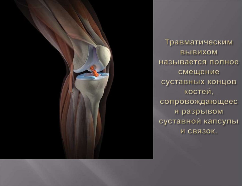 Травматическим вывихом называется полное смещение суставных концов костей, сопровождающееся разрывом суставной капсулы и