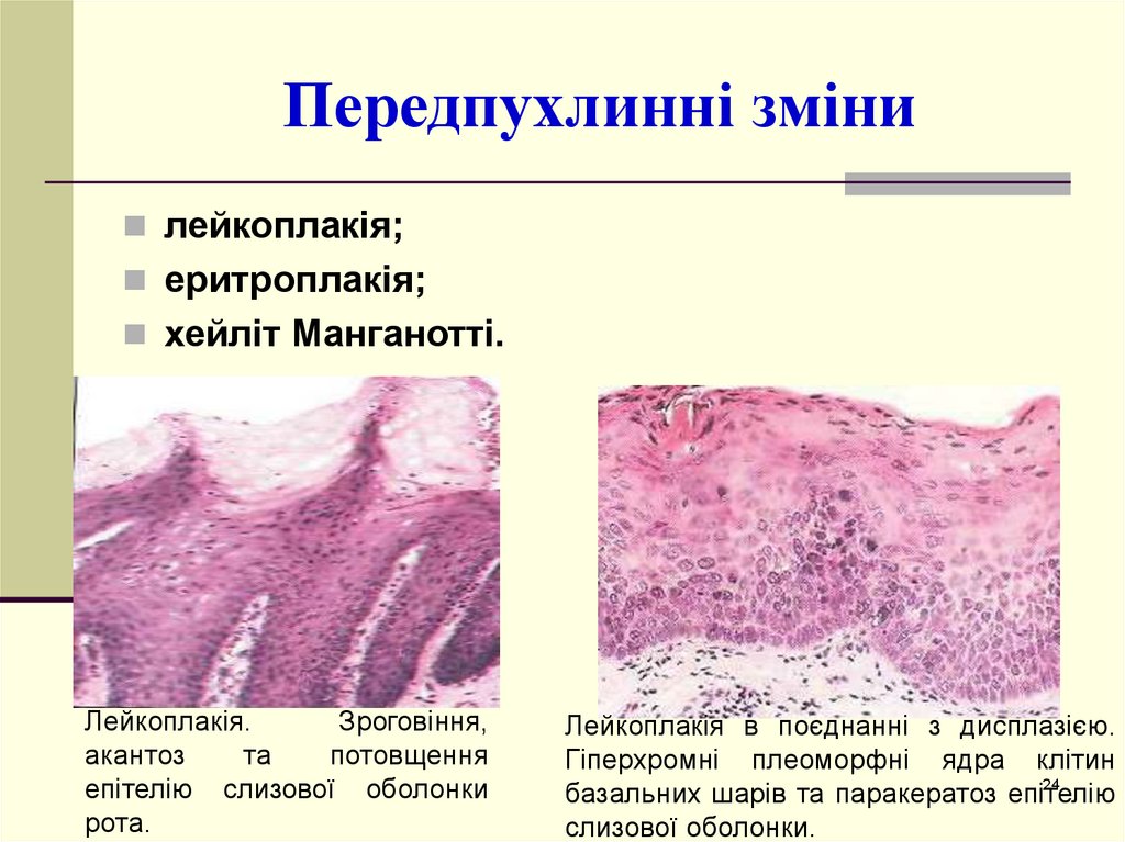 Десквамация. Хейлит Манганотти гистология. Абразивный преканкрозный хейлит Манганотти. Хейлит Манганотти патанатомия. Абразивного преканцерозного хейлита Манганотти.