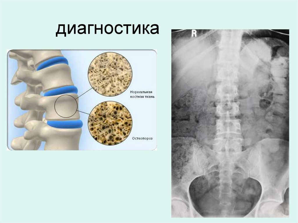 Остеопороз. Пострадиационный остеопороз. Остеопороз презентация. Презентация по остеопорозу.