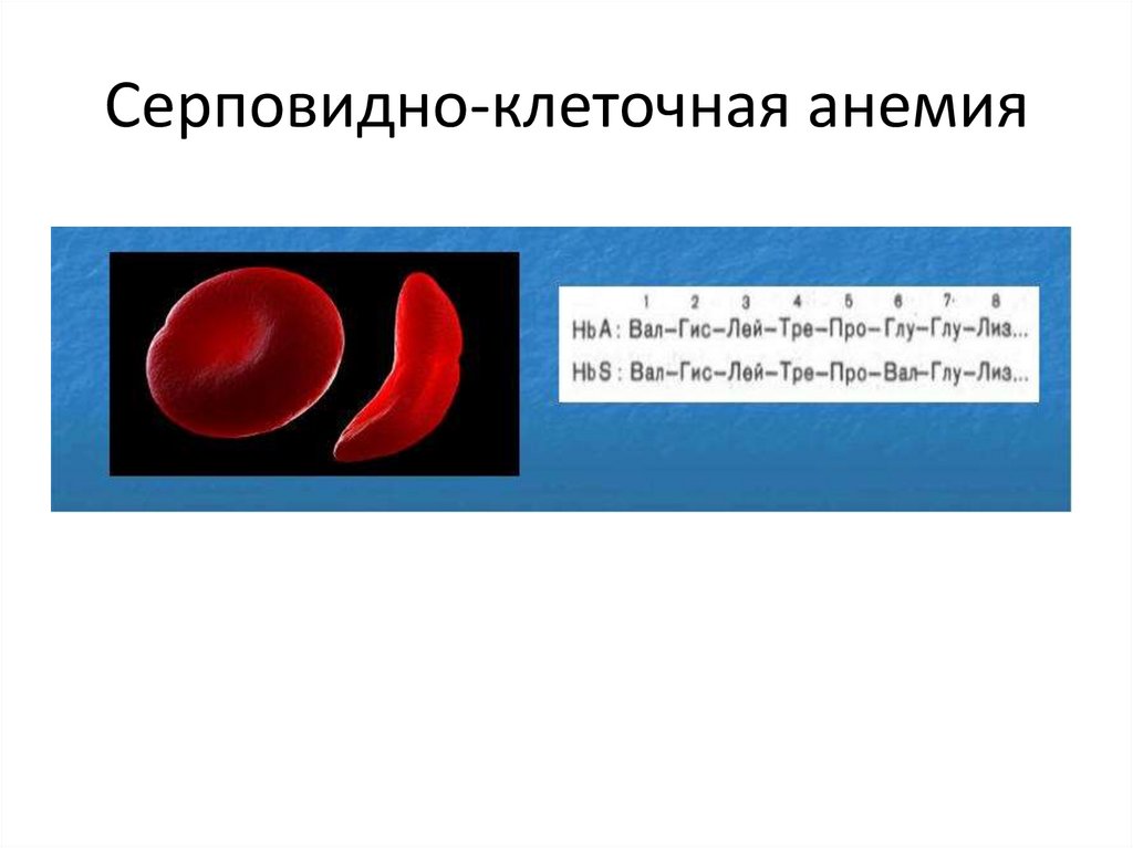 Серповидноклеточная анемия картинки