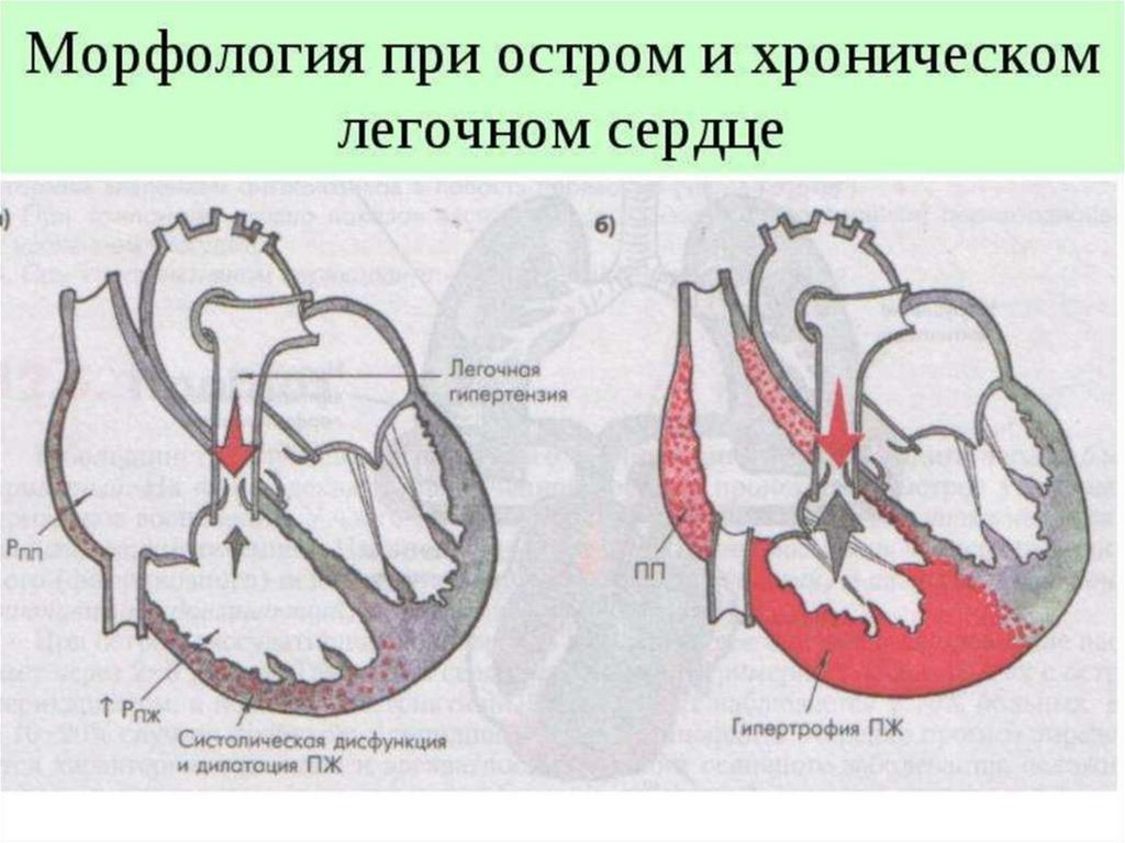 Легочное сердце картинки