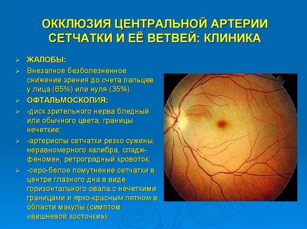Клиника глаза сетчатки. Окклюзия ветви артерии сетчатки. Окклюзия артерии сетчатки. Окклюзия центральной артерии сетчатки и ее ветвей.