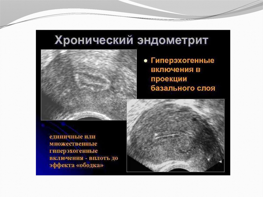 Эндометрий д. Гиперэхогенный полип эндометрия. Гиперплазия эндометрия эндометрит. Гиперплазия эндометрия матки на УЗИ.