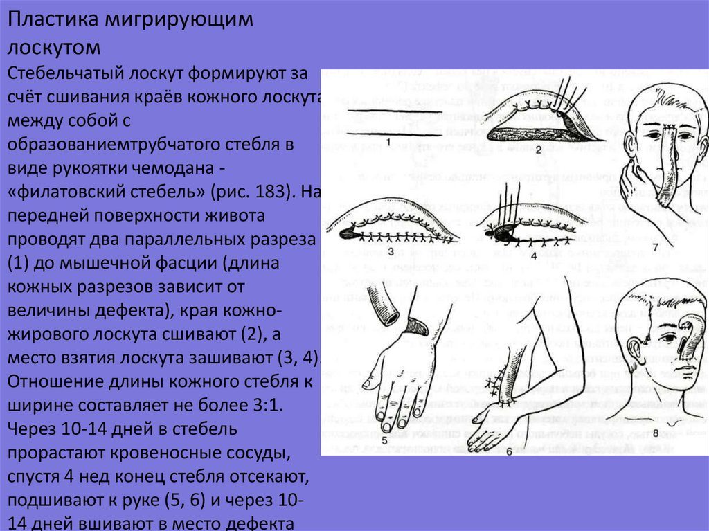 Лоскут рука. Кожная пластика стебельчатым лоскутом. Пластика мигрирующим лоскутом. Мигрирующие кожные лоскуты.